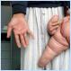 The largest hand in the world will be looking forward to a normal life after undergoing radical plastic surgery! [Pics]